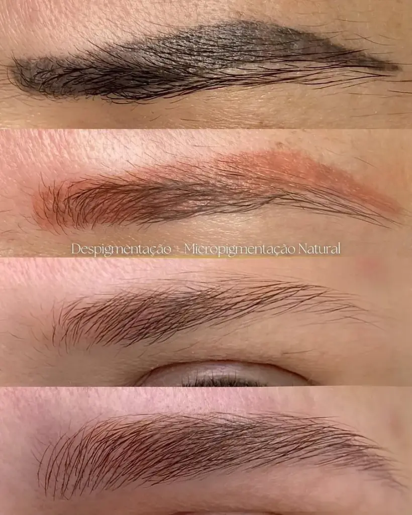 Antes e depois de remoção a laser de micropigmentação antiga de sobrancelhas
